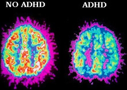 Adhd Is Genetic: Know Your Child's Chances