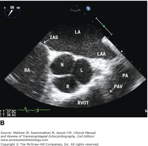 Aortic Valve Cusps