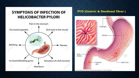 H Pylori Communicable