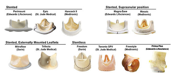 How Do Aortic Valve Cusps Fail? Repair Options