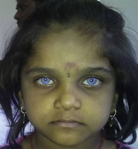 How Is Klein Waardenburg Syndrome Diagnosed?