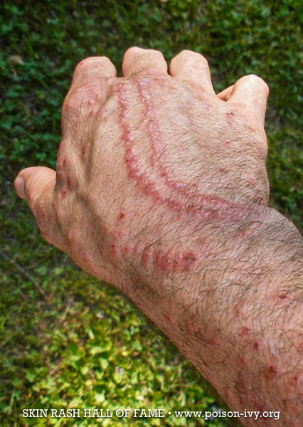 How To Recognize Poison Ivy The Plant And The Rash The Baynet