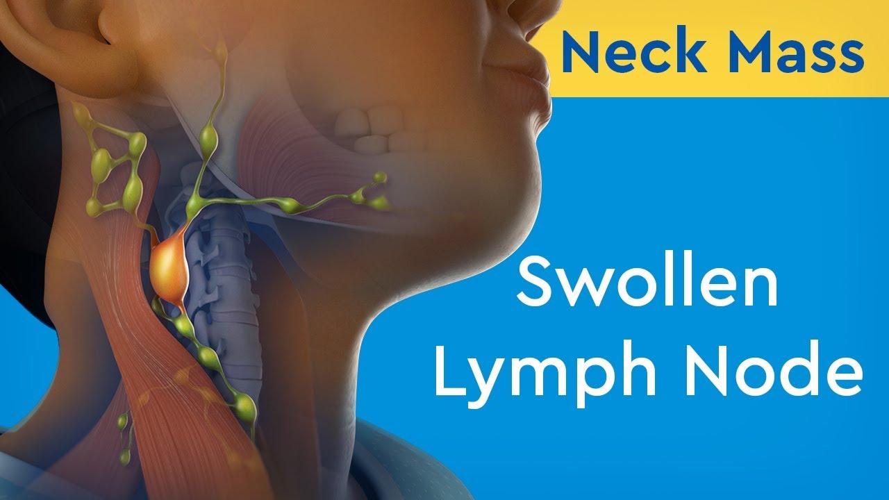 How We Can Treat Swollen Lymph Node Naturally Youtube