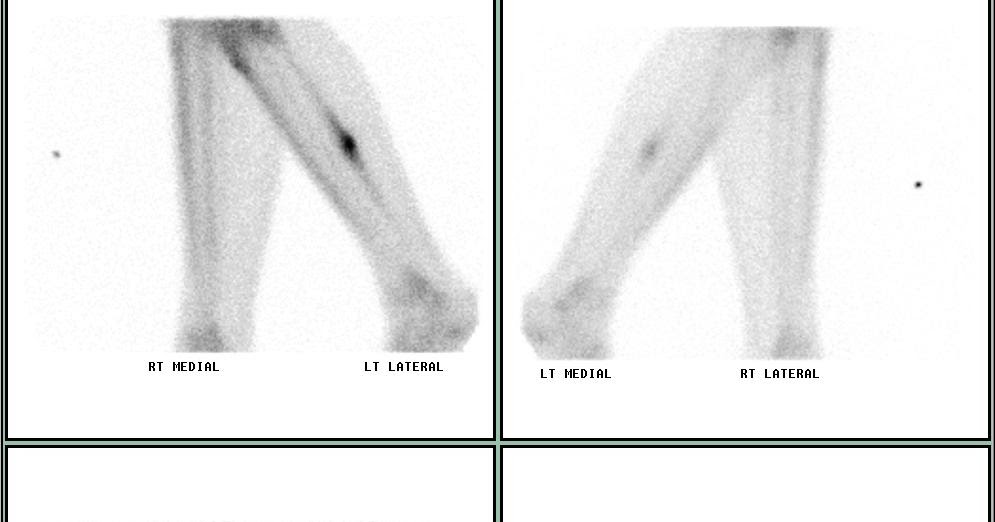 Stress Fracture Or Shin Splints